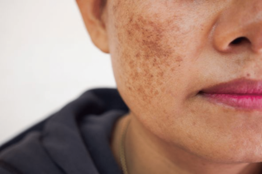 Hyperpigmentation et taches brunes : les actifs qui font vraiment la différence